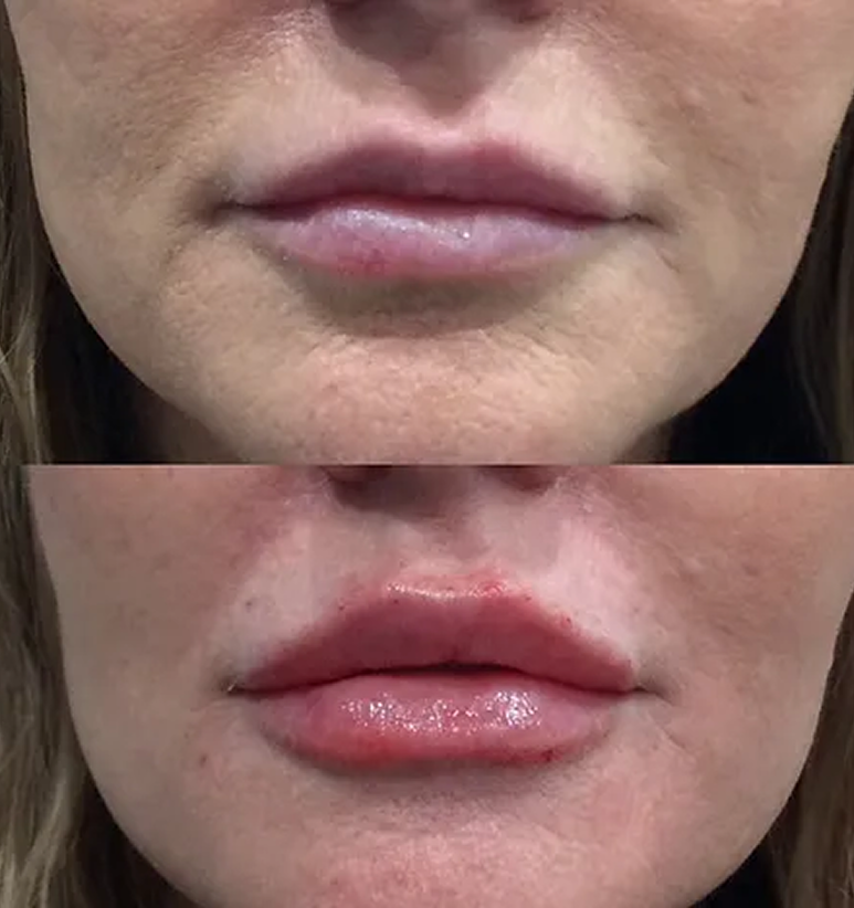 Lip Filler