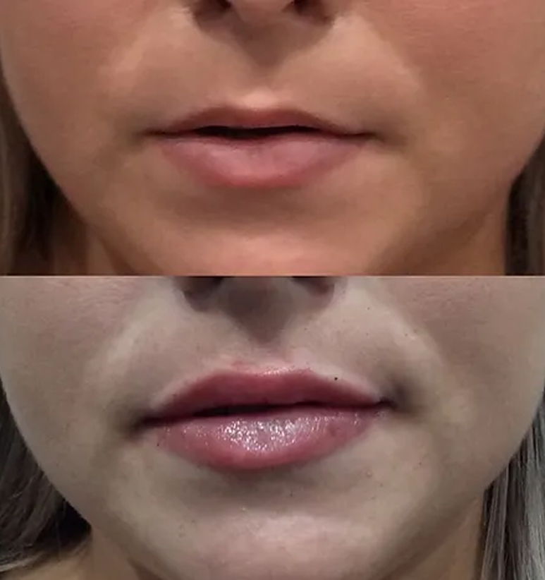 Lip Filler