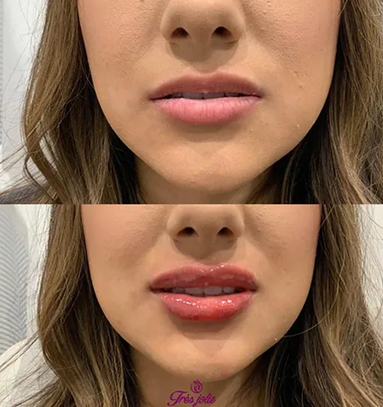 Lip Filler