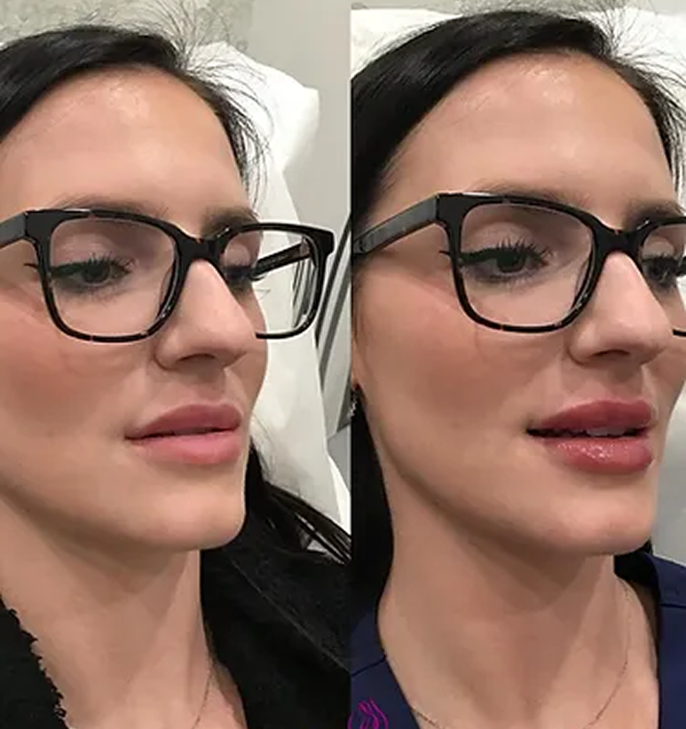 Lip Filler