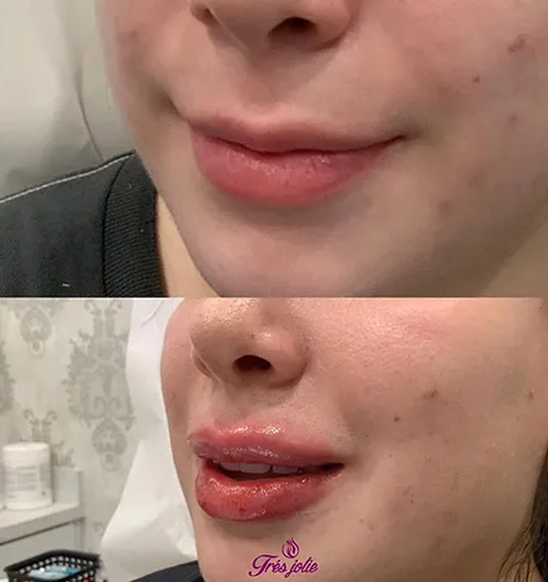 Lip Filler
