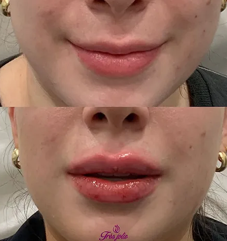 Lip Filler
