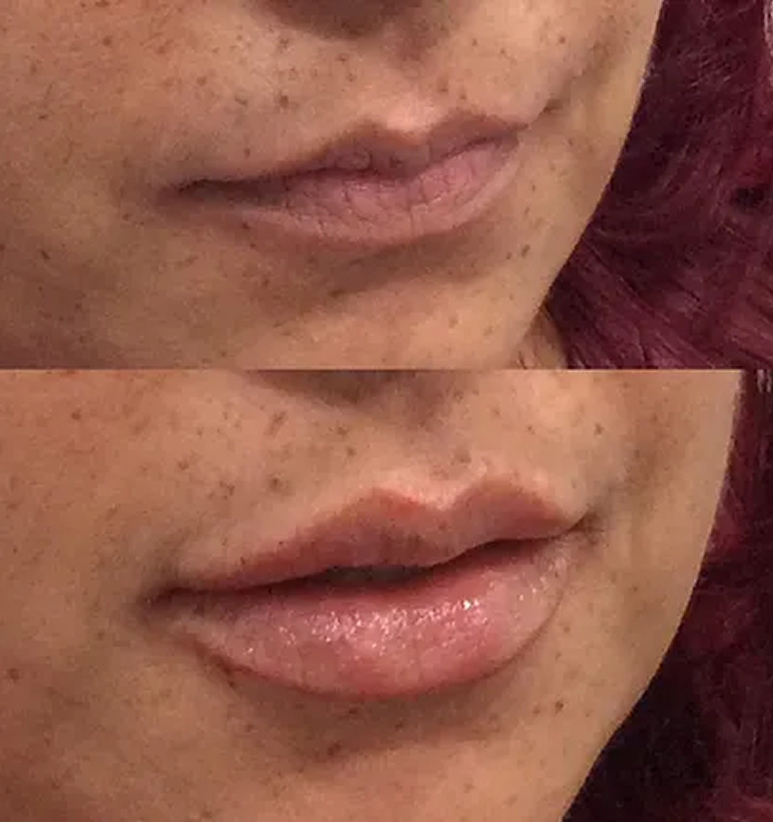 Lip Filler