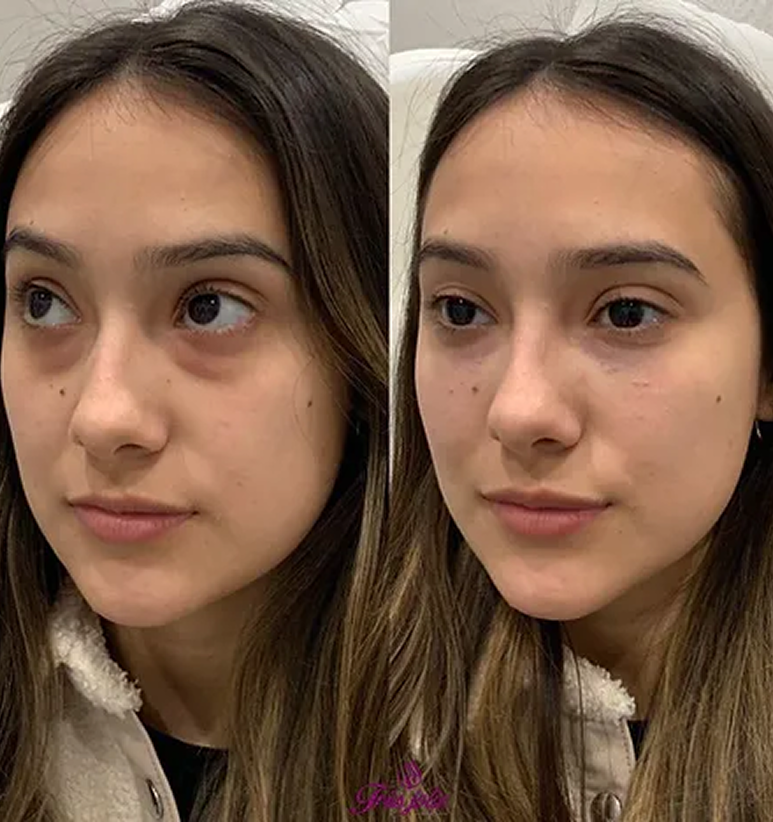 Undereyes