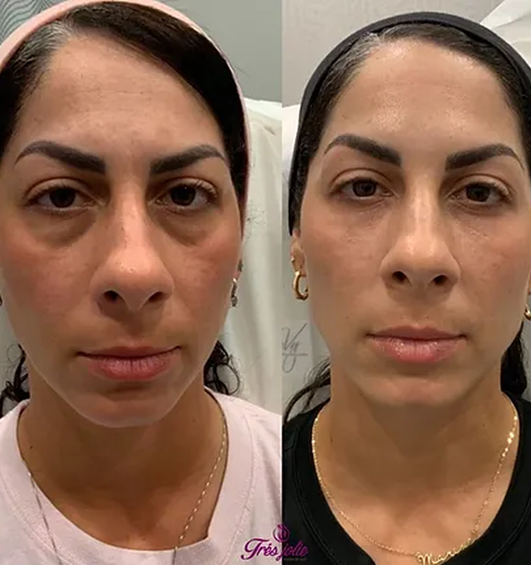 Undereyes