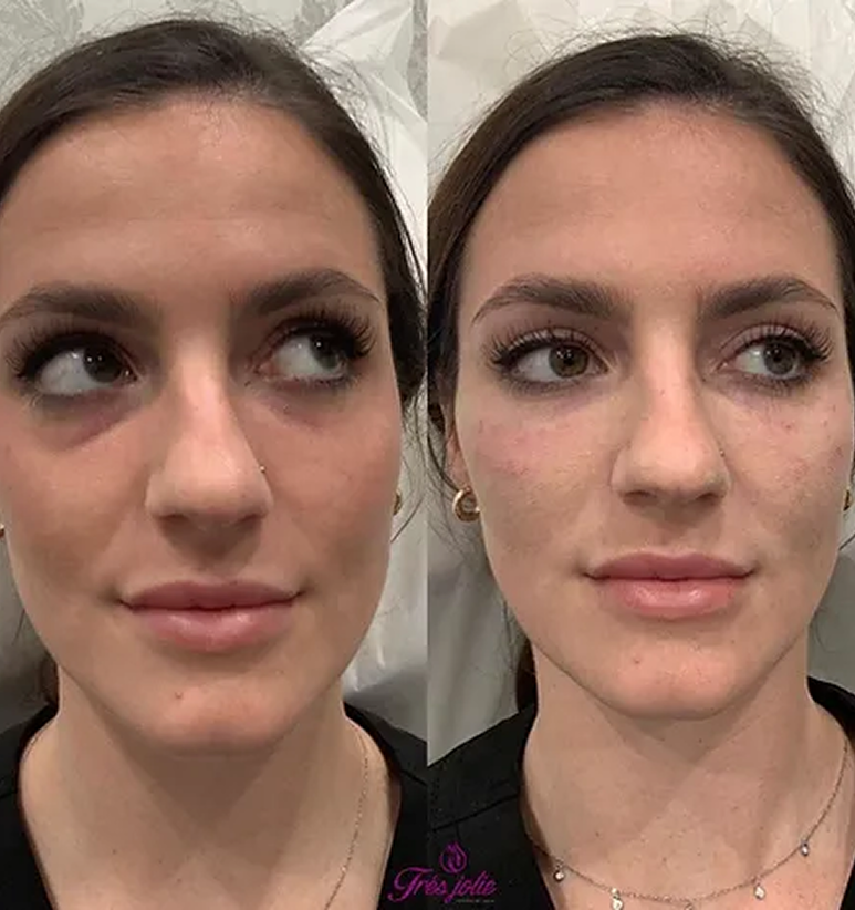 Undereyes