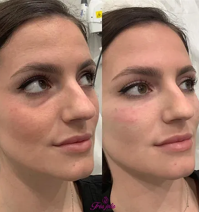 Undereyes