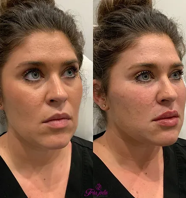 UndereyesUndereyes