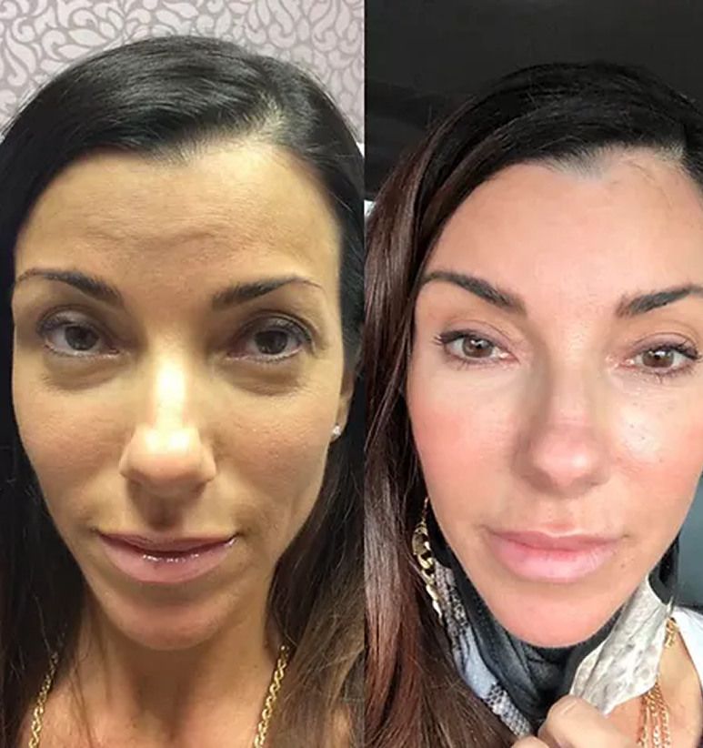 Undereyes