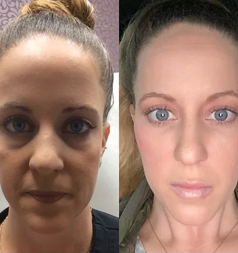 Undereyes