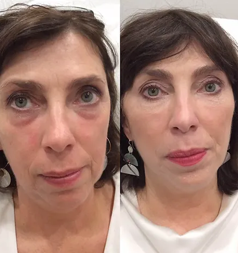 Undereyes