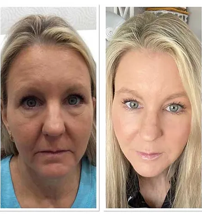 Undereyes
