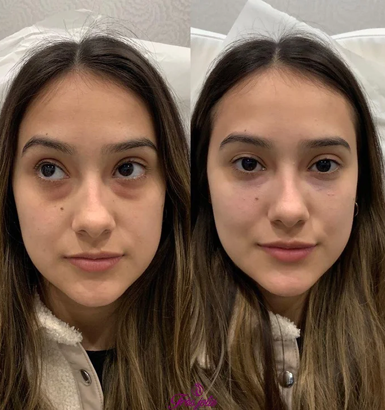 Undereyes