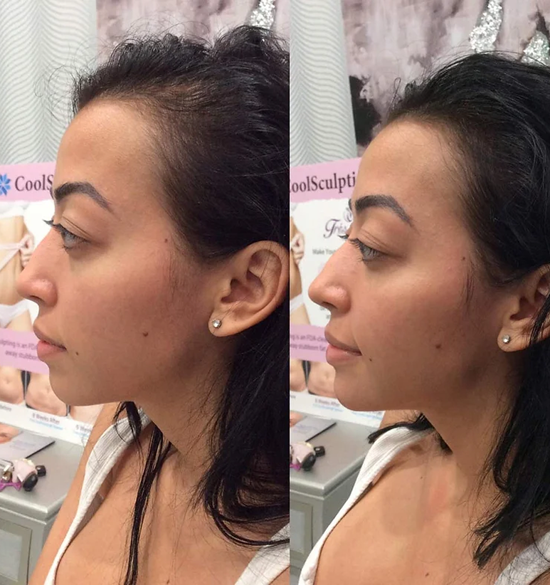 Chin Filler