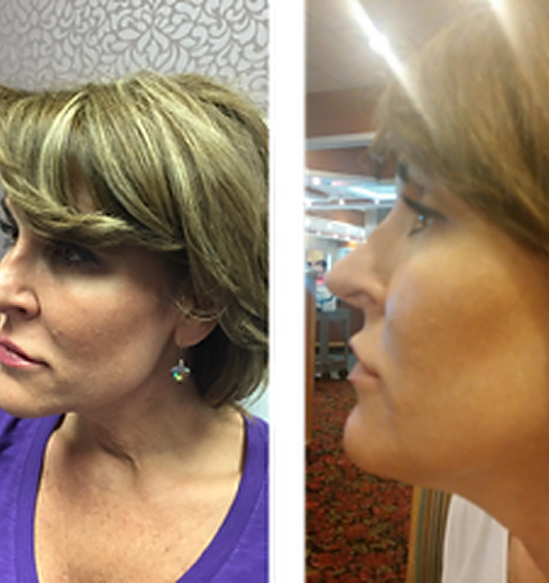Chin Filler