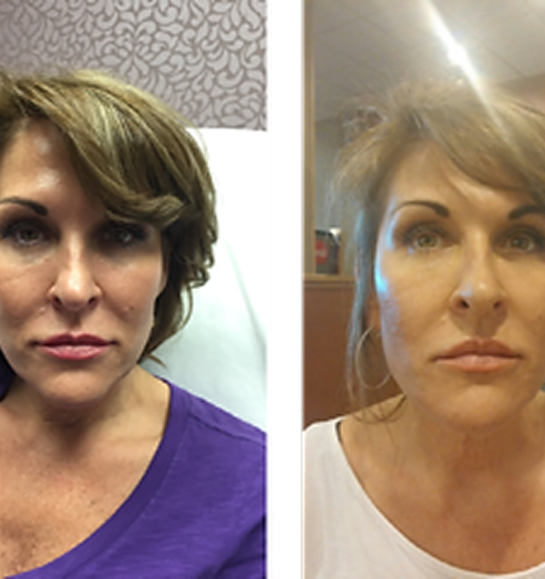 Chin Filler