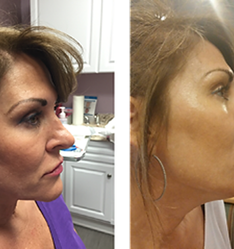 Chin Filler