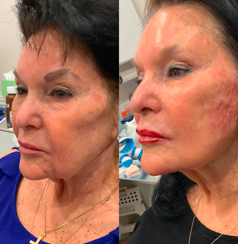 Jawline Filler